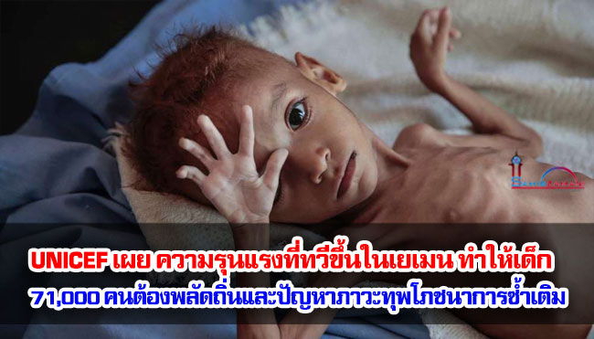 UNICEF เผย ความรุนแรงที่ทวีขึ้นในเยเมน ทำให้เด็ก 71,000 คนต้องพลัดถิ่นและปัญหาภาวะทุพโภชนาการซ้ำเติม